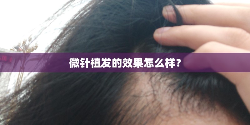 微针植发的效果怎么样? 微针植发的效果怎么样?