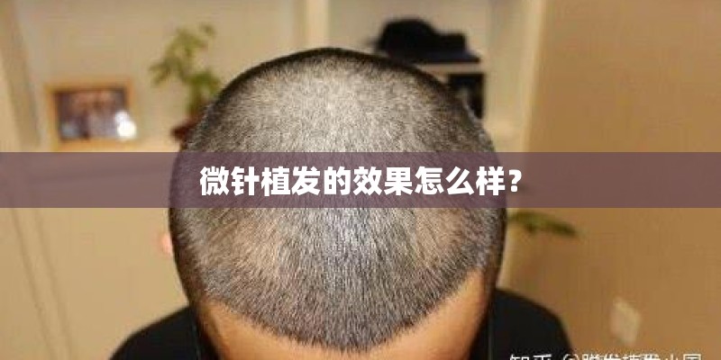 微针植发的效果怎么样? 微针植发的效果怎么样?