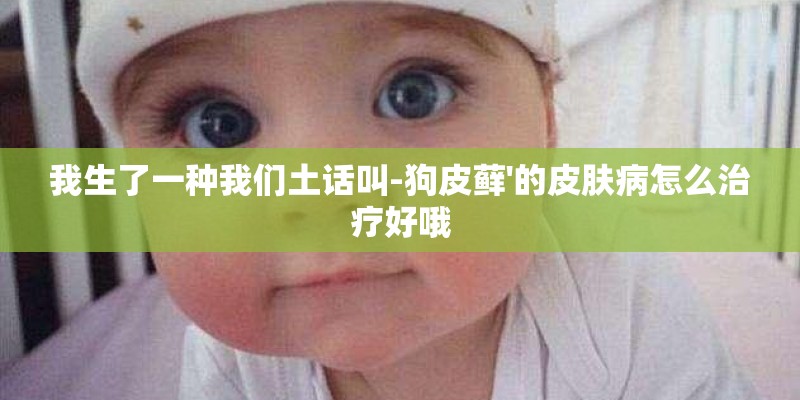 我生了一种我们土话叫-狗皮藓'的皮肤病怎么治疗好哦